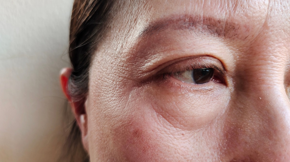 โรคหนังตาตกในผู้สูงอายุ