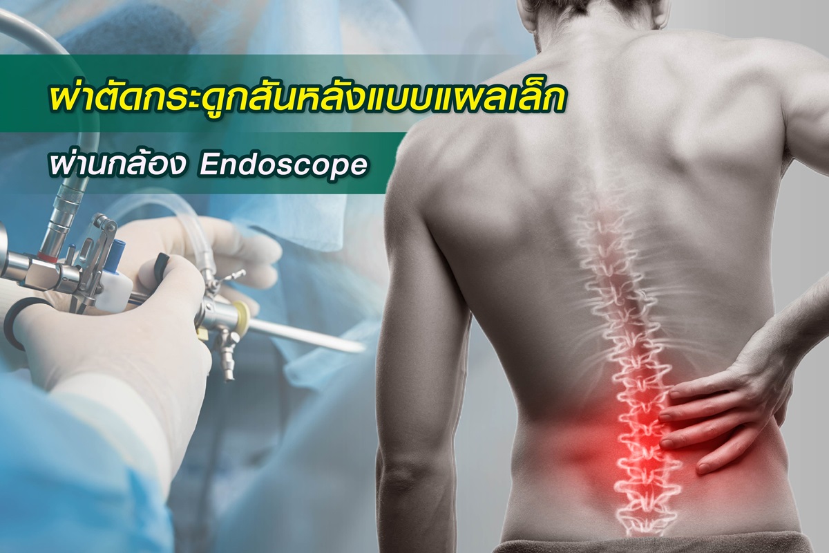 ผ่าตัดกระดูกสันหลังผ่านกล้อง Endoscope “พักฟื้นเร็ว แผลเล็ก และเจ็บน้อย”