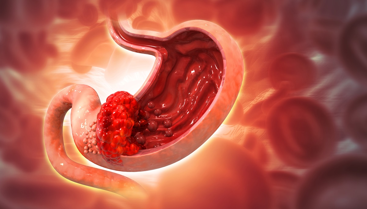 เทคโนโลยีใหม่! อองโคเทอร์เมีย (Oncothermia) ทางรอดผู้ป่วยมะเร็งกระเพาะอาหาร