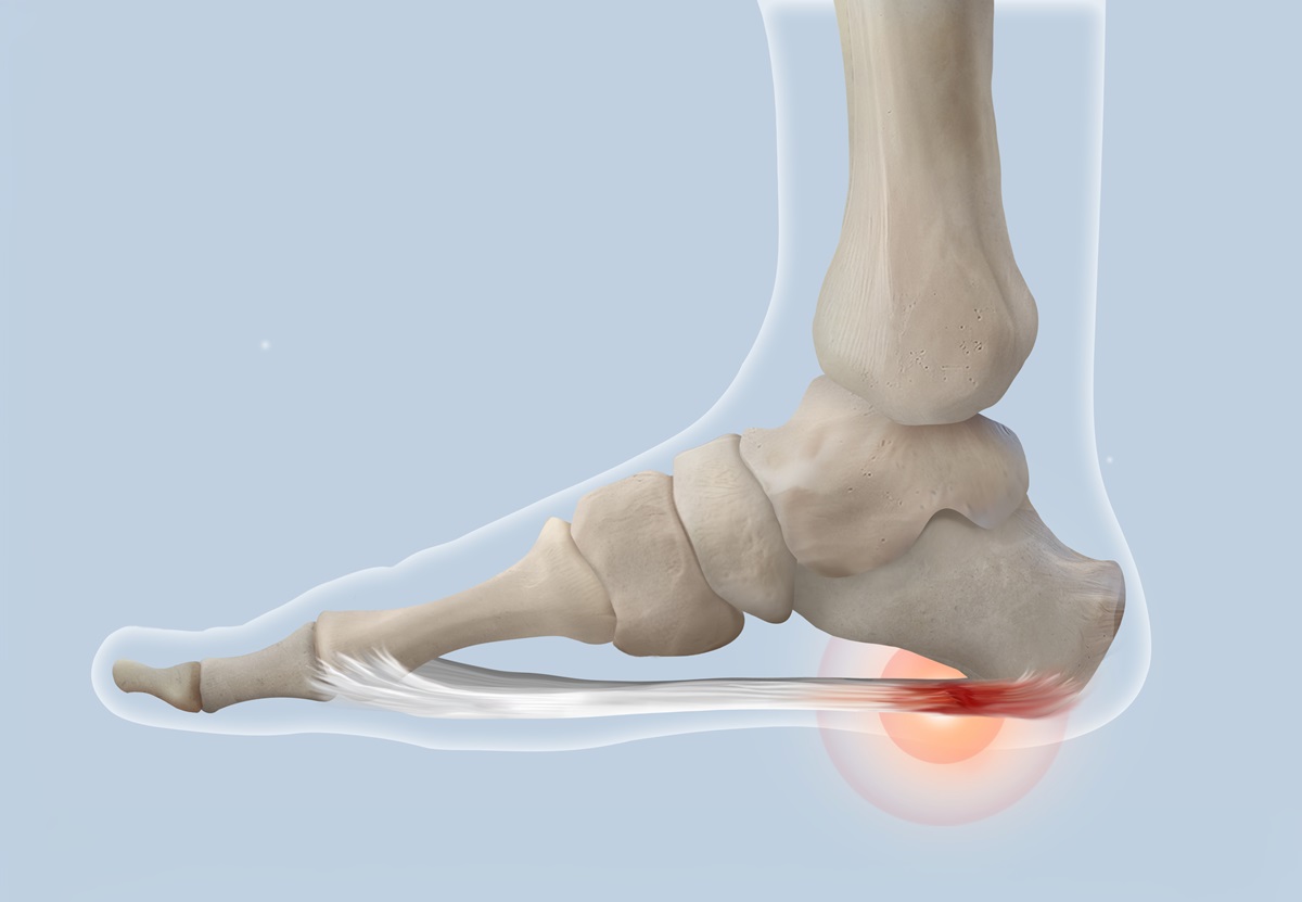 Plantar,Fasciitis,Anatomy,Medical,Illustration
