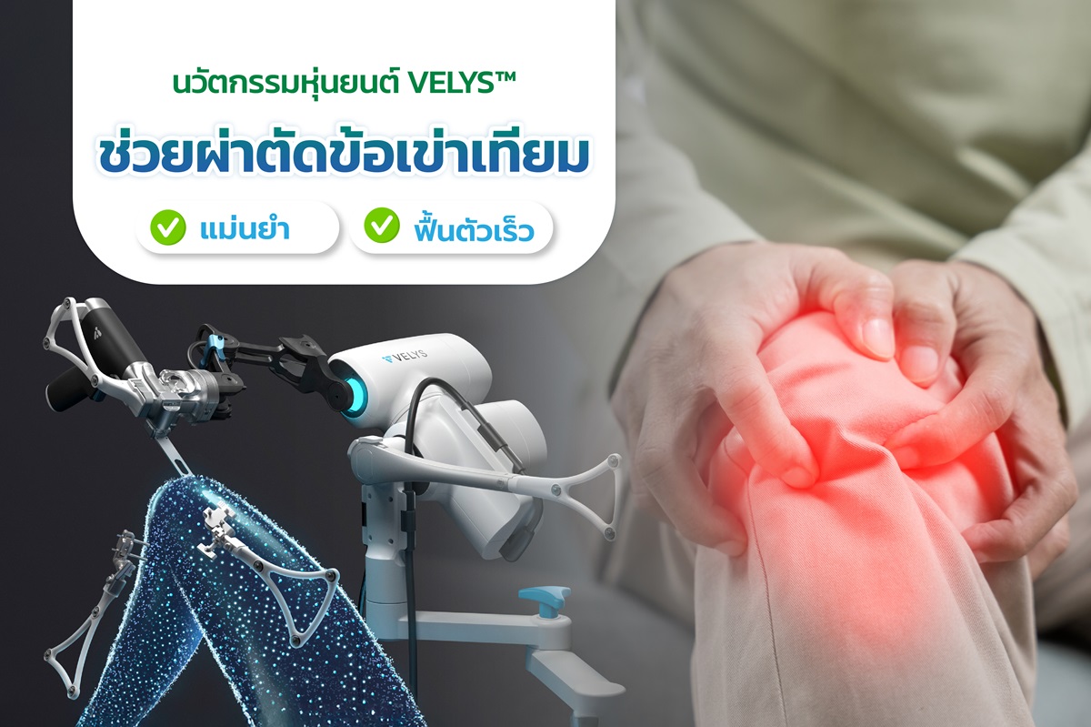นวัตกรรมหุ่นยนต์ VELYS™ ช่วยผ่าตัดข้อเข่าเทียม